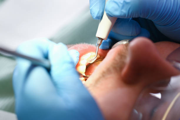 Best Emergency Dental Care for Broken or Chipped Teeth in St Albans, VT