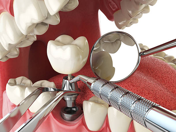 Best Emergency Treatment for Dental Infections or Abscesses in St Albans, VT